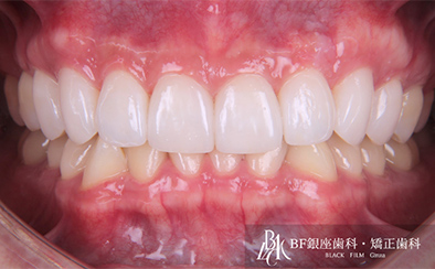 After image