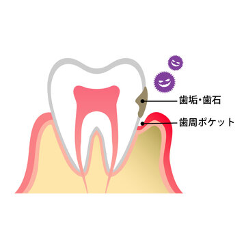 歯周ポケット